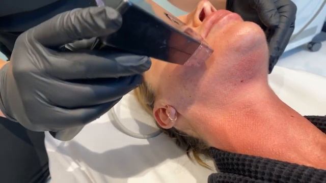 MORPHEUS8 GAVE ME A SNATCHED JAWLINE | RADIOFREQUENCY MICRONEEDLING TREATMENT | Dr. Jason Emer смотреть онлайн