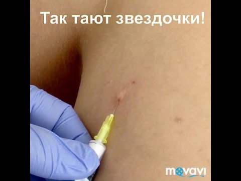 Склеротерапия