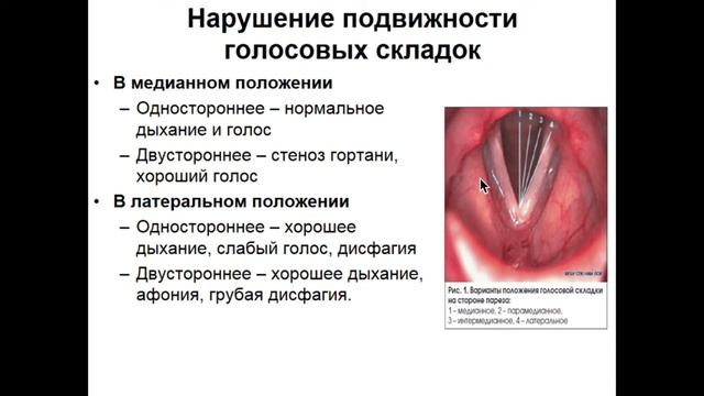 Анатомия, физиология, патология гортани.