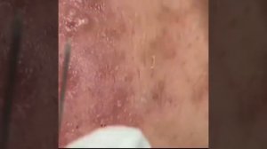 Выдавливание акне (ПРЫЩЕЙ)