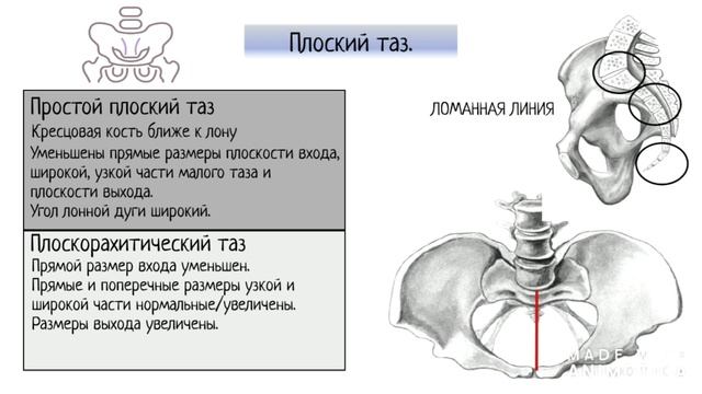 Узкий таз