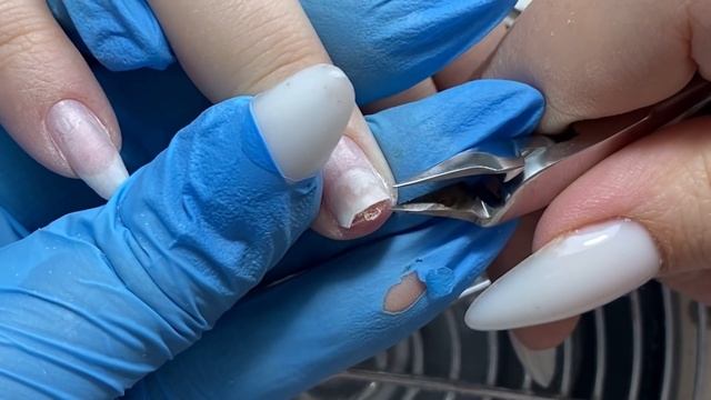 Вырвала ноготь в мясо в драке?| Травма| Онихолизис и зачистка смотреть онлайн