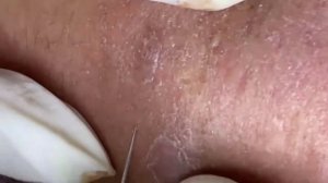 Relaxing Acne Treatment Acnes Treatment  72