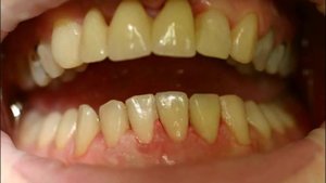 Метод снятия оттиска закрытой ложкой