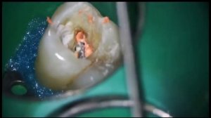 Пломбировка корневых каналов 16 зуба , лечение каналов зуба