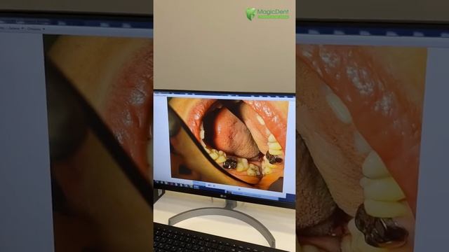 Лечение кариеса в Сочи. Зачем нужен фотопротокол до и после лечения?