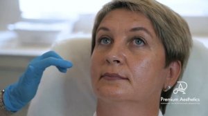 Отзыв о фотоомоложении на аппарате М22