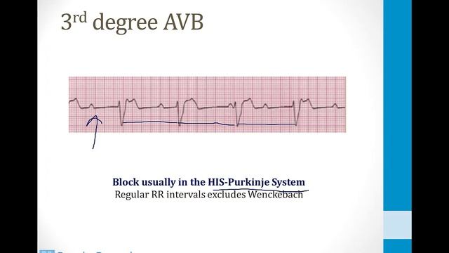 Кардиология USMLE - 4. Аритмии - 2.АВ блокада и ветвей пучка