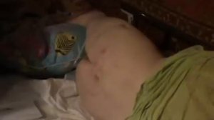 пролежни