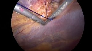 IPOM - plus umbilical hernia repair. Лапароскопическая пластика пупочной грыжи