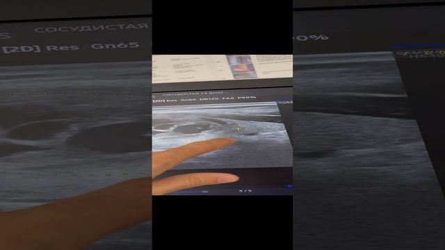 Случайная находка при узи сонных артерий. Узел в щитовидной железе. Сосудистый хирург. Флеболог смотреть онлайн