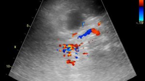 осложненный лимфаденит..