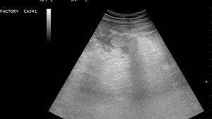 полтный аппендикулярный инфильтрат