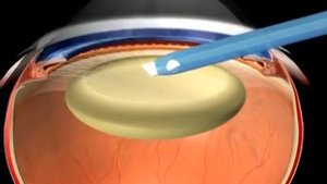 Что такое катаракта и как её вылечить?