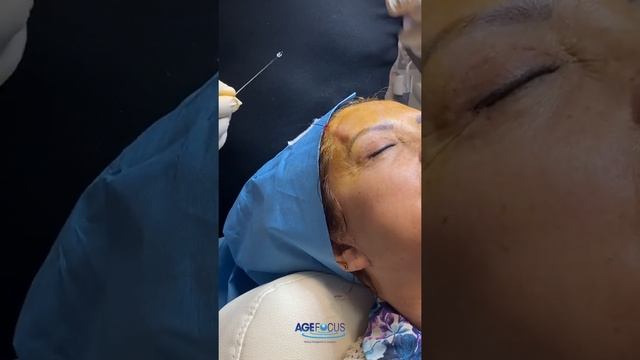 PDO Thread Lift at AgeFocus смотреть онлайн