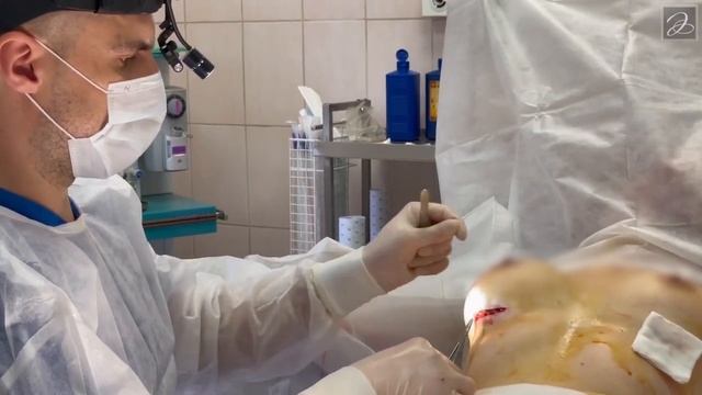 Увеличение груди анатомическими имплантами под грудную мышцу