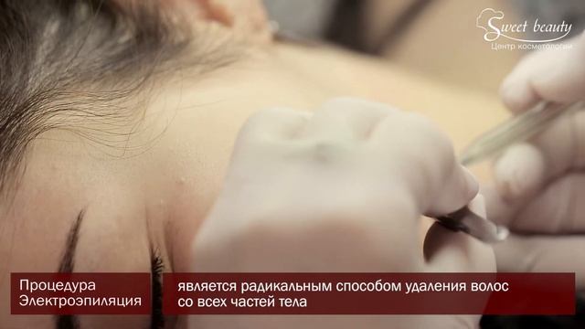 Электроэпиляция
