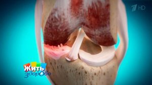 Боль в коленном суставе. Жить здорово! Фрагмент выпуска от 19.10.2015