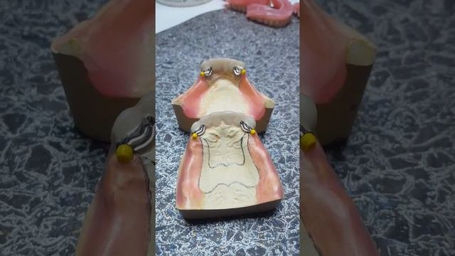 Протезирования бюгельные и металлокерамически зубов поэтапно clasp dentures with metal ceramics