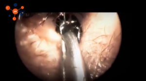 Врачи опешили увидев ЭТО в УХЕ! Слабонервным не смотреть!