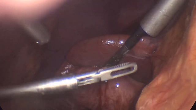 Лапароскопическая холецистэктомия. Эмпиема желчного пузыря смотреть онлайн