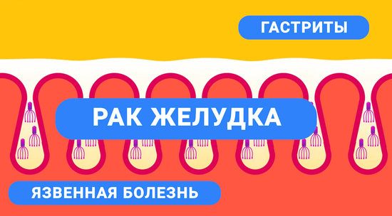 Врачи напомнили о коварстве хеликобактер пилори: вызывает рак