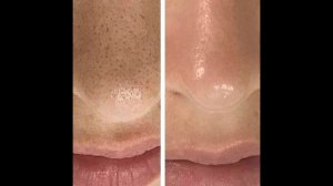 Расширенные поры на лице. Как сузить поры в домашних условиях.