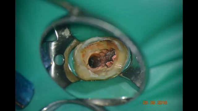 Извлечение культевой вкладки смотреть онлайн