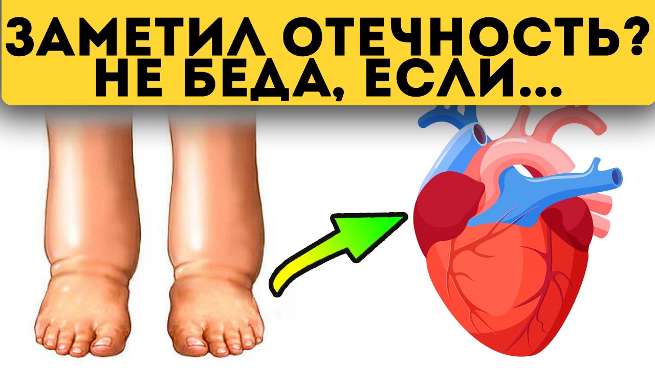 Как проверить отечность. Сердечные отеки и почечные отличие. показать отечность сердце.