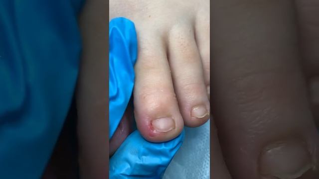 Онихокриптоз - (вросший ноготь₽ смотреть онлайн