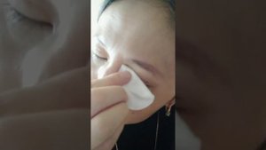 нитевая блефаропластика 2 ши кун