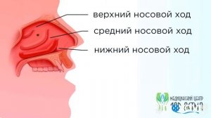 Синдром постназального затекания