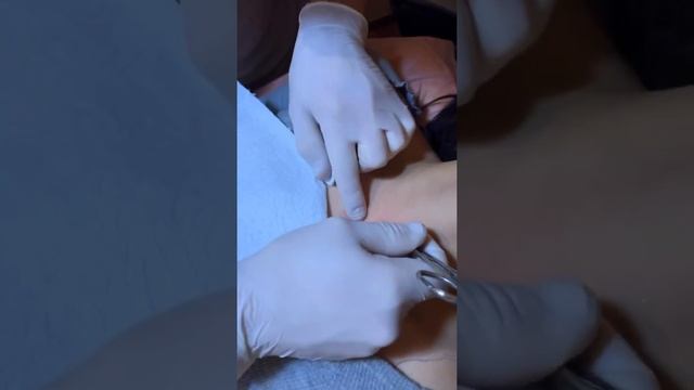 Как быстро поставить микродермал смотреть онлайн