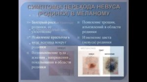 Атипичный невус  Отличия от меланомы