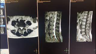 МРТ после операции по удалению грыжи диска смотреть онлайн