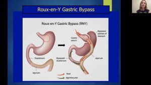 Gastric Bypass and S.I.B.O.