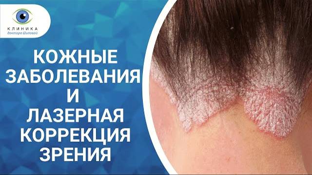 Кожные заболевания (псориаз, нейродермит) и лазерная коррекция зрения смотреть онлайн