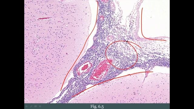 Pathoma USMLE - VI ГЛАВА - 2.Острый лейкоз