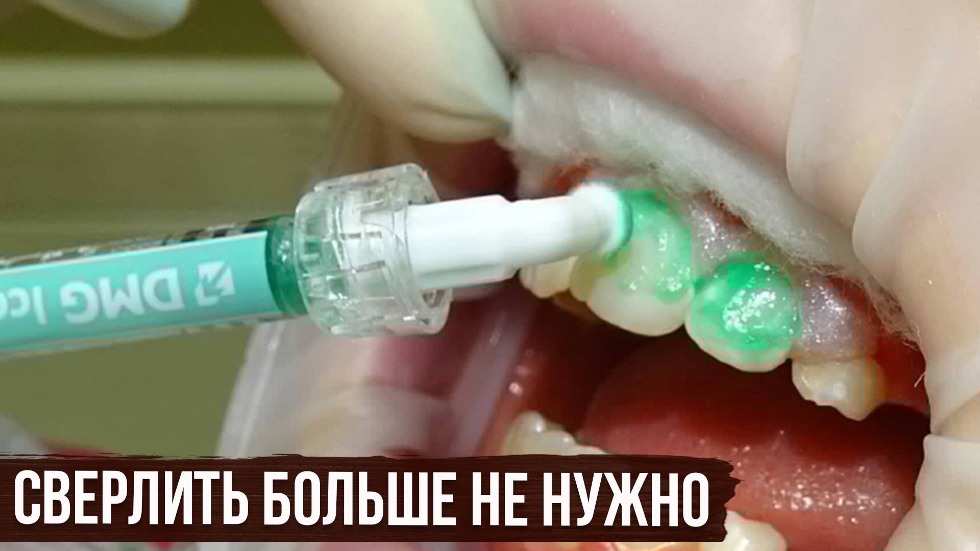 Лечение Кариеса без сверления и боли