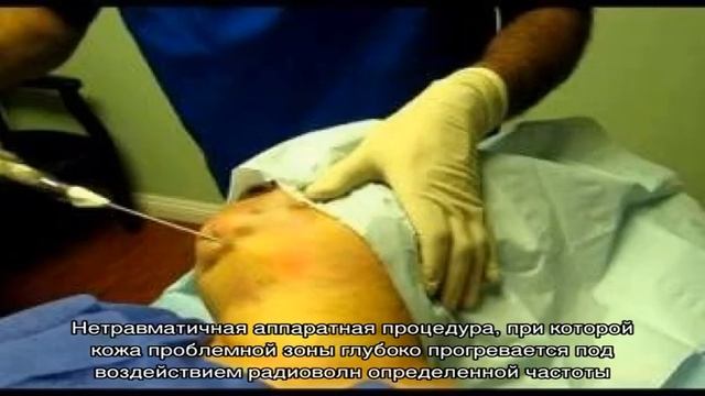 Лифтинг подбородка и шеи