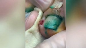 Удаление вросшего ногтя у ребёнка