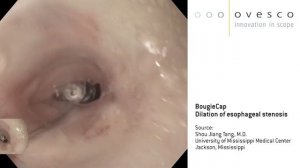 Бужирование пищеводного стеноза аппликационным колпачком BogieCap