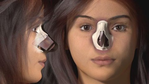Rhinoplasty for the crooked nose. SPQR PRESERVATION PUSH DOWN CLOSED RHINOPLASTY/ KAMINSKYI