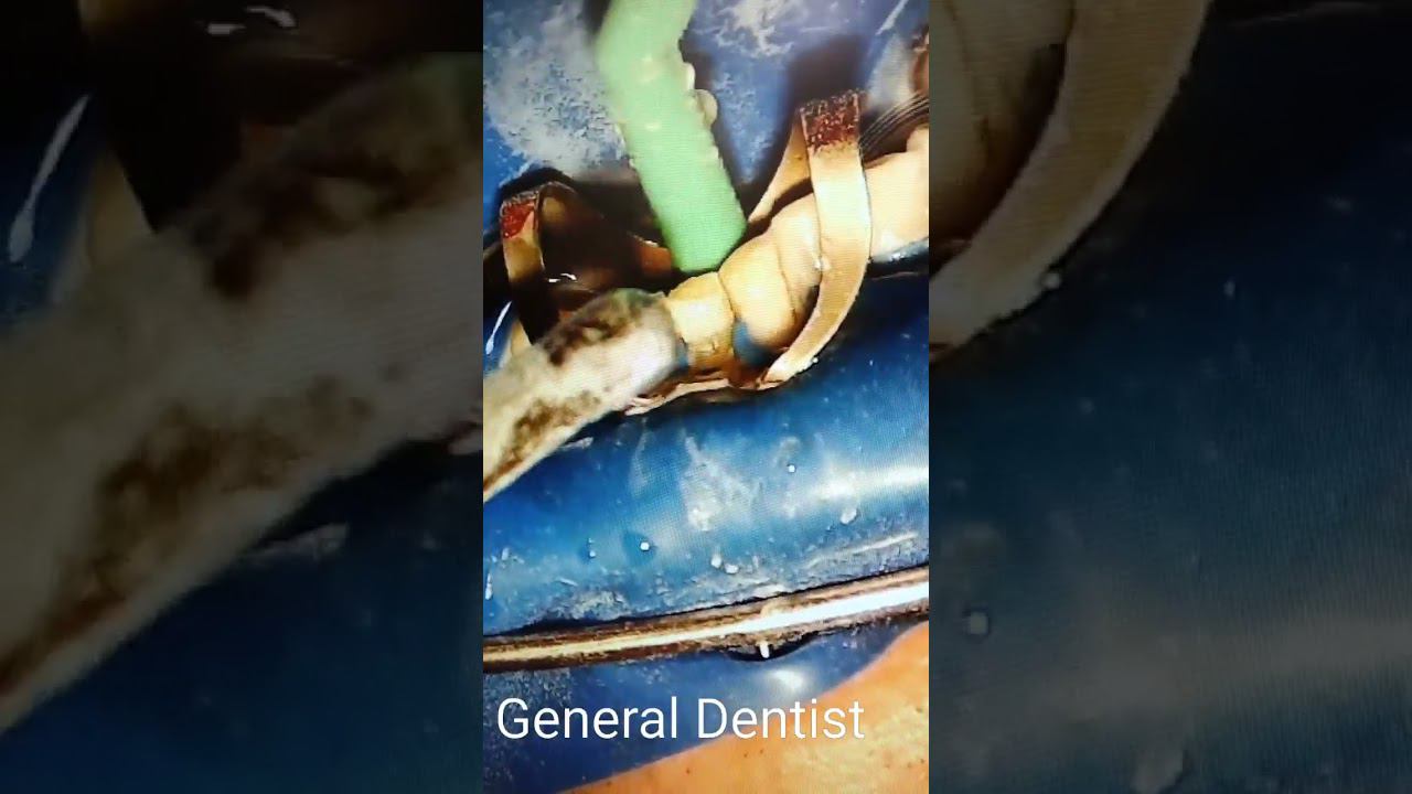 Abrasive treatment of the surface of teeth.Multi cases. Videos 11 minutes.