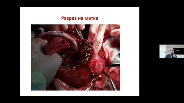 Органосохраняющие операции при акушерских кровотечениях Баринов С.В. смотреть онлайн