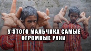 У этого мальчика нереально огромные руки
