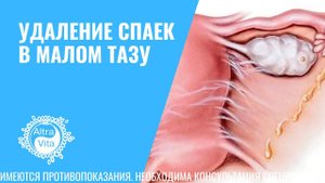 УДАЛЕНИЕ СПАЕК В МАЛОМ ТАЗУ #гинеколог #гинекология