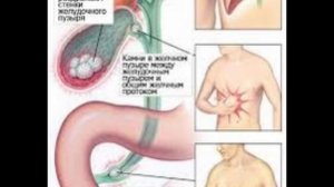 Xolesistit , ot pufagi yaliglanishi, Холецистит