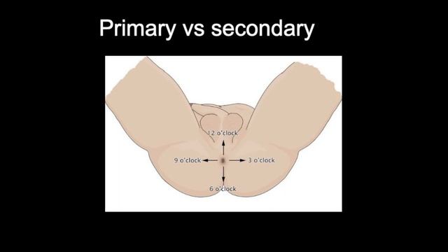 Doctor explains ANAL FISSURE including causes classification and treatment options
