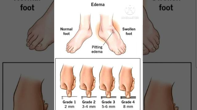 Edema /// Subscribe for more videos